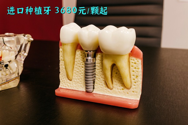 合肥鑲牙的價格表，3種鑲牙方式你pick哪一個？