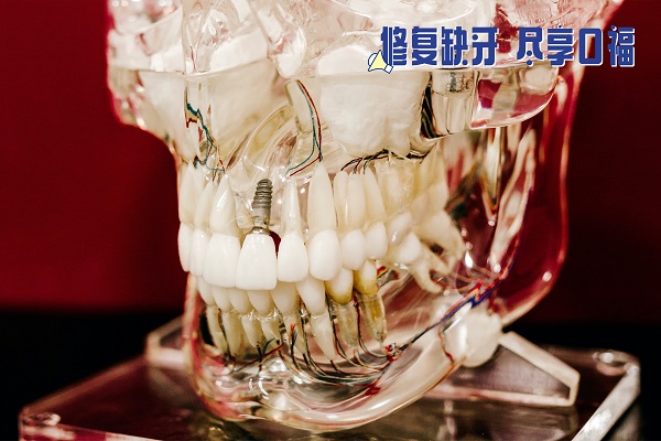 合肥鑲牙的價格表，種植牙/活動假牙/烤瓷牙優缺點大pk！