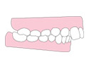 前牙外突(齙牙)