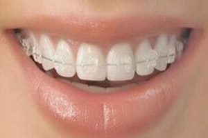 前牙開頜矯正需要注意什么？