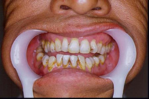頜紊亂的常見因素是什么呢？