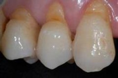 牙齒楔狀缺損是什么意思？