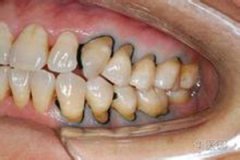 牙齒楔狀缺損如何修復？