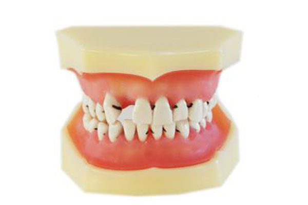 牙齒不齊可分為哪幾類？