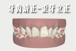 牙齒深覆牙合能矯正嗎？