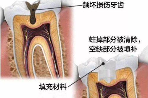 合肥補牙洞多少錢-哪種材料補得好用的久？